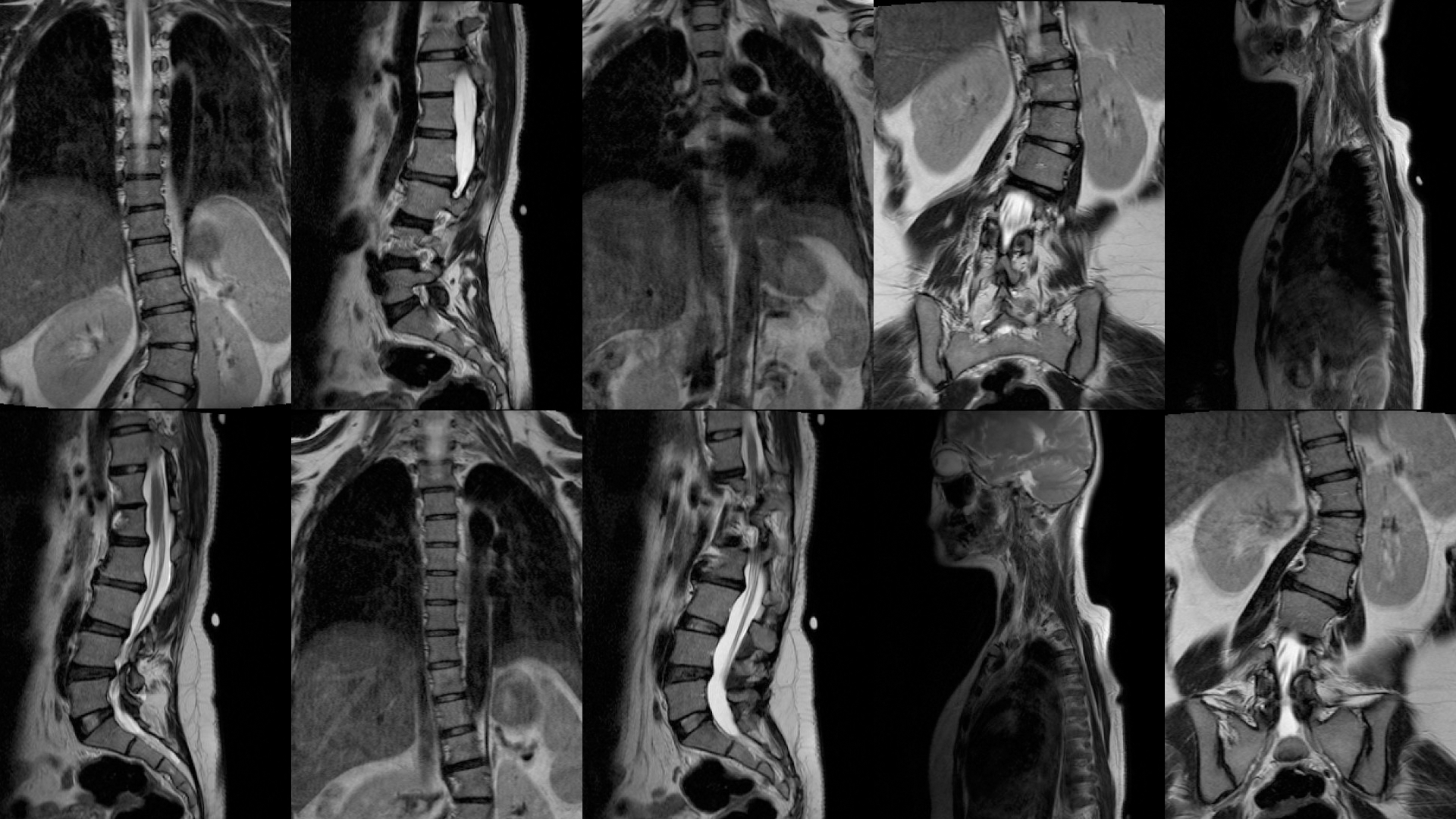 MRI scan of Evon Toh's back